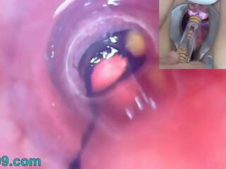 Endoskopkamera för en mogen kvinnas blåsendoskop med ballonger (Bisarra Sex Video)